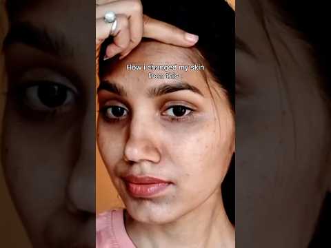 How I changed my skin from this !?✨👩🏼 #skincare #beauty #glowbeauty #newglow #glowupchallenge
