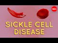 Sickle Cell Disease and Malaria