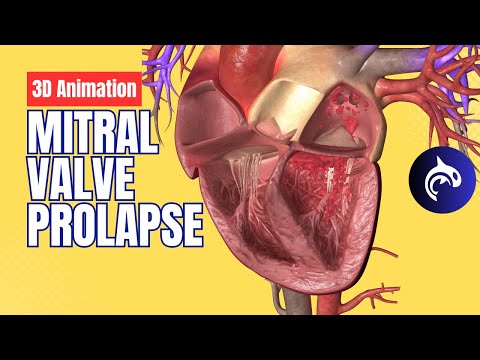 Mitral Valve Prolapse - 3D Animation