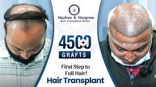4,555 Grafts Hair Transplant in Ahmedabad | Amazing Results & Affordable Cost #hairtransplant