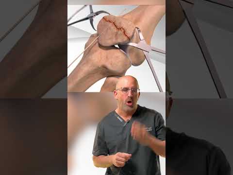 Shattered Kneecap ๐จ Repair #shorts