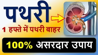 "1 हफ्ते में पथरी बाहर! "पथरी का इलाज अब आसान!
