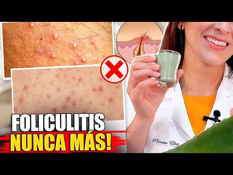 ¡Elimina la FOLICULITIS en las Axilas, la Ingle, la Barba y Más!