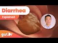 Understanding Diarrhea: Causes and Types
