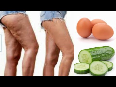 4 powerful treatment that get rid of varicose veins and bumpy thigh