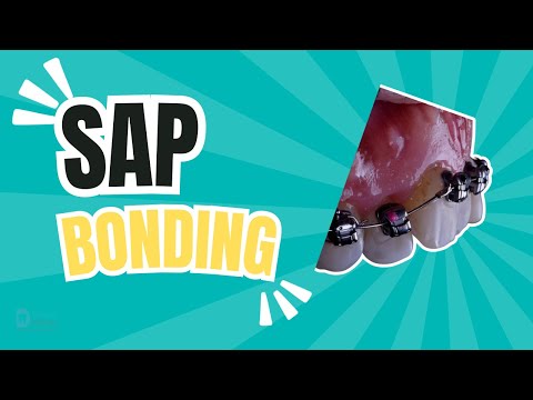 SAP bonding