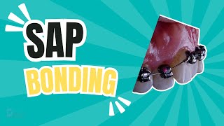 SAP bonding