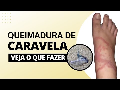 Queimadura de Caravela - Veja o que fazer