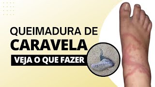 Queimadura de Caravela - Veja o que fazer