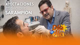 🦷🚨 Afectaciones bucales por sarampión | Dr. Sergio Siordia en Día a Día