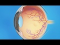 Understanding Diabetic Retinopathy and Vitrectomy Surgery