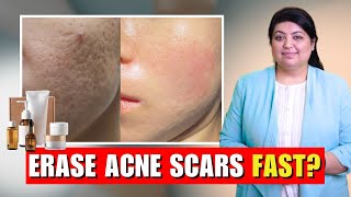 Dermatologist-Recommended Acne Scar Creams & Serums | Dr Nivedita Dadu