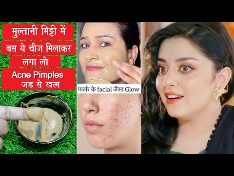 मुल्तानी मिट्टी ऐसे लगालो- सारे Acne Pimples और दाग धब्बे जड़ से ख़त्म हो जाएगे/ Get Clear Fair Skin