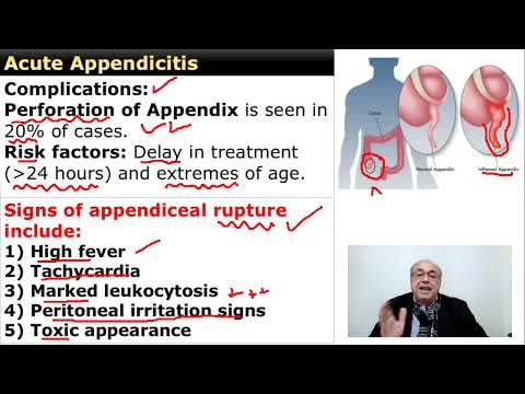 Acute Appendicitis     #internal_medicine  #cme #usmle #محاضرات_باطنة