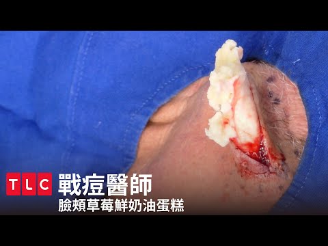 《戰痘醫師》草莓鮮奶油蛋糕|TLC 旅遊生活頻道