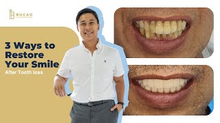 3 Ways to Restore Your Smile After Tooth Loss