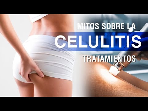 Celulitis: Mitos más comunes | Tratamientos