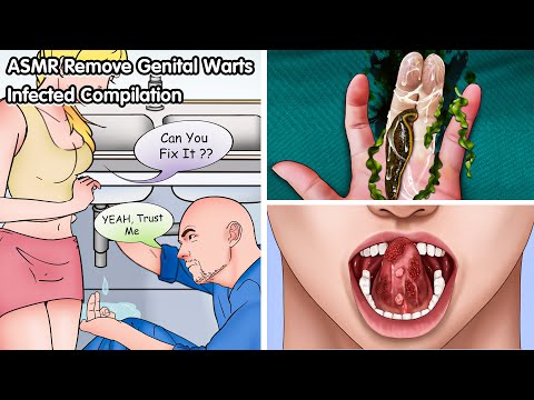 ASMR Get Rid of Genital Warts FAST with this Deep Cleaning Animation!