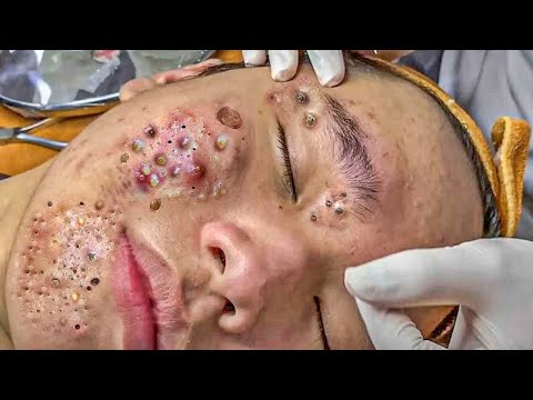 Blackhead Removal With Today Spa #2442