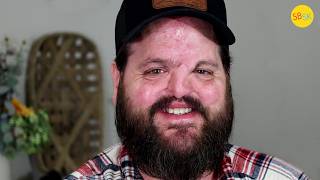 Born Without a Nose and Rejected by His Parents (Now He's 50)