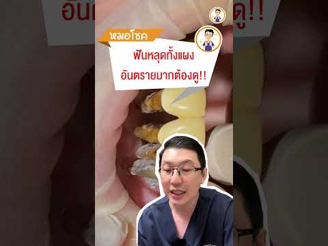 ฟันหลุดทั้งแผงอันตรายต้องดู!! | #หมอโชค #รากฟันเทียม #คลายปัญหารากเทียมกับหมอโชค