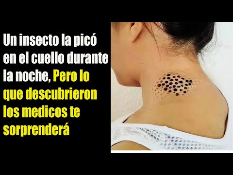 UN INSECTO LE PICO EL CUELLO DURANTE LA NOCHE, PERO LO QUE DESCUBRIERON LOS MÉDICOS SORPRENDIÓ