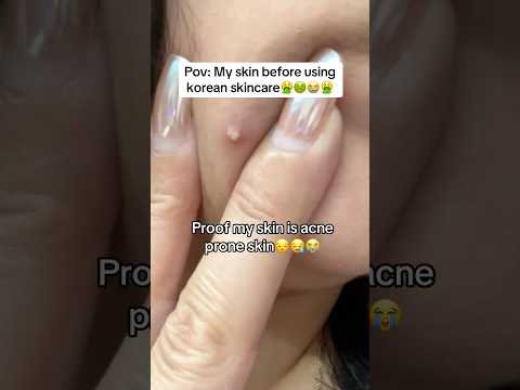 My skin before using korean skincare😱 😪 My skin after using korean skincar #shorts  #youtubeshorts