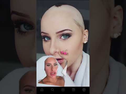 My high school hairloss journey! #bald #alopecia #hairloss