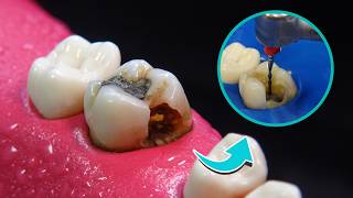 Restauración dental: tratamiento de conductos e incrustación tipo inlay