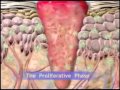 Wound Healing in the Integumentary System