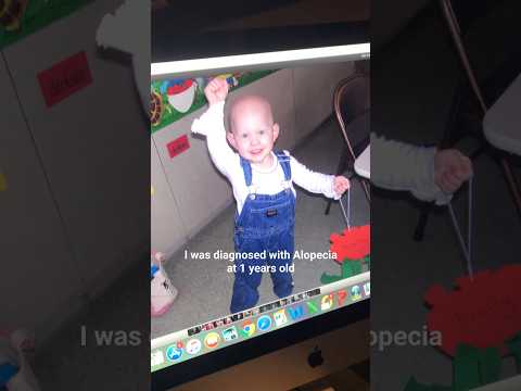 A little bit of my Alopecia story🫶🏻💙