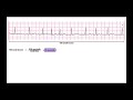 EKG Rhythm Calculation Methods