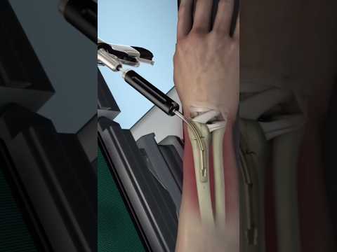 Bone Fracture Repair 💫