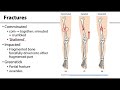 Fracture Types and Treatment Concepts
