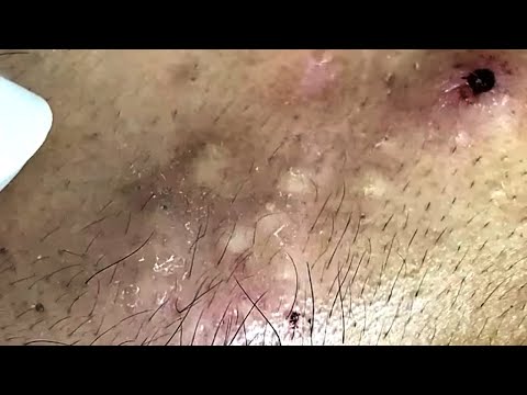 Blackheads & Whiteheads Satisfying Removal @0611