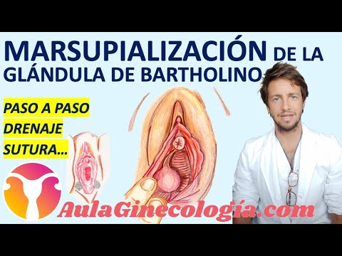 DRENAJE y MARSUPIALIZACIÓN DE LA GLÁNDULA DE BARTHOLINO: TÉCNICA QUIRÚRGICA PASO A PASO. Ginecología