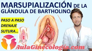 DRENAJE y MARSUPIALIZACIÓN DE LA GLÁNDULA DE BARTHOLINO: TÉCNICA QUIRÚRGICA PASO A PASO. Ginecología