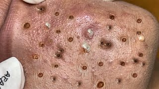 Blackhead Removal With Sac Dep Spa @100074688