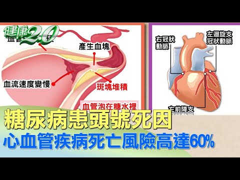 糖尿病患頭號死因 心血管疾病死亡風險高達60%  健康2.0