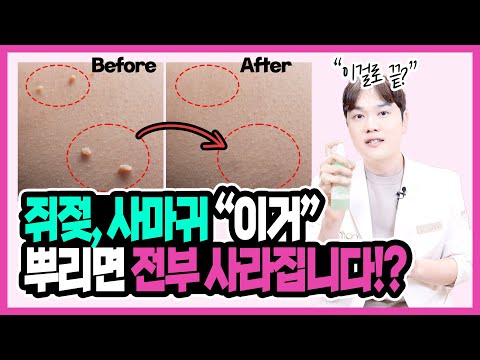 "이거" 뿌리면 쥐젖, 사마귀 똑 떨어진다고? 현직의사가 알려주는 쥐젖, 편평사마귀 없애는 방법