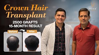 Crown Hair Transplant Result: 2500 Grafts Before & After (15 Months)