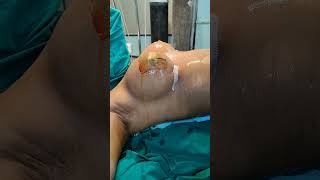 375cc Breast implant before and after