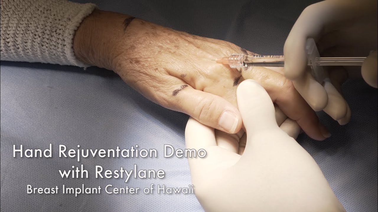 Cosmetic Hand Lift (Rejuvenation) with Restylane - Breast Implant Center of Hawaii