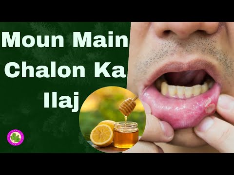 Muh Ke Chale Ki Dawa | Mouth Ulcer Treatment