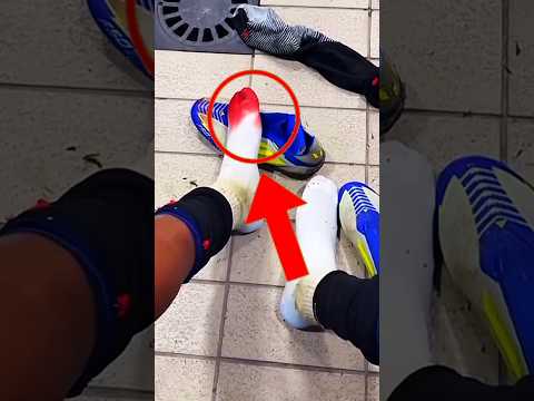 Le dribbleur au sang : pourquoi Lamine Yamal saigne-t-il à chaque match ? #yamal #shorts