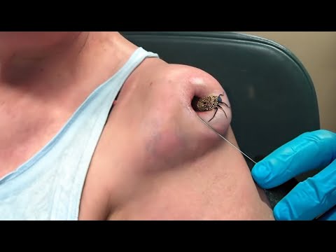 a bug got stuck in his arm...