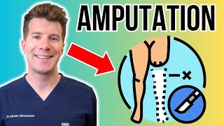 Doctor explains Limb Amputation | Procedure, recovery and more