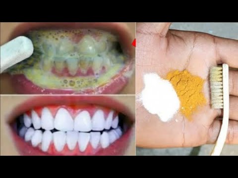 Teeth whitening and scaling at home in 1 minute 💯 you will get pearl white teeth