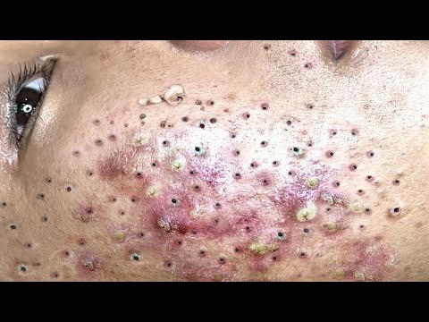 Blackhead Removal With Sac Dep Spa @100074057