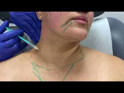 Woman with markings for cosmetic procedure preparation.